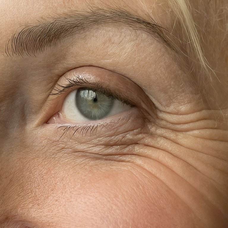 crow's feet wrinkles